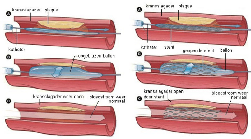 Een dotter- en stentbehandeling (img-large)